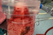 A novel system to "vacuum" thrombus and tumors from veins used for the first time at UCC MUW